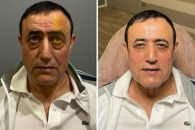 Urfalı Sarkıcı Estetik Furyasına Katıldı