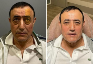 Urfalı Sarkıcı Estetik Furyasına Katıldı