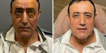 Urfalı Sarkıcı Estetik Furyasına Katıldı