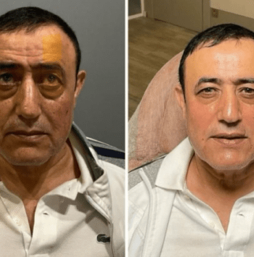 Urfalı Sarkıcı Estetik Furyasına Katıldı