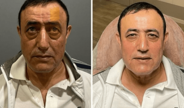 Urfalı Sarkıcı Estetik Furyasına Katıldı