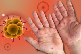 maymun çiçeği urfa bugun